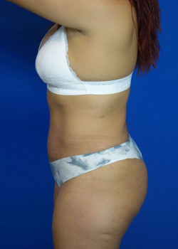 Drainless Tummy Tuck with Liposuction