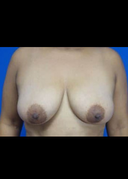 Breast Aumentation with Mastopexy (Breast Lift)