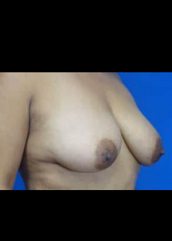 Breast Aumentation with Mastopexy (Breast Lift)