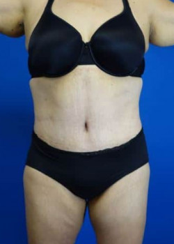 Drainless Tummy Tuck with Liposuction