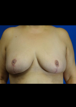 Breast Lift and Reduction
