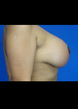 Breast Aug and Mastopexy (Breast Lift)