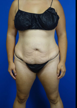 Drainless Tummy Tuck w/ Liposuction