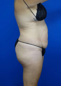 Drainless Tummy Tuck w/ Liposuction
