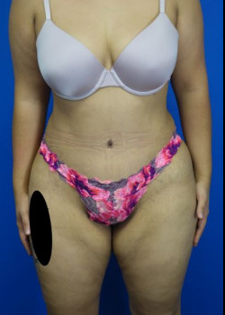 Drainless Tummy Tuck and Liposuction