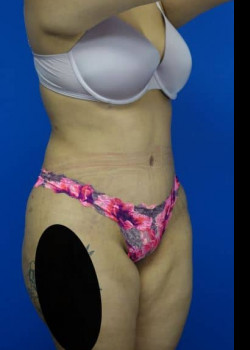 Drainless Tummy Tuck and Liposuction